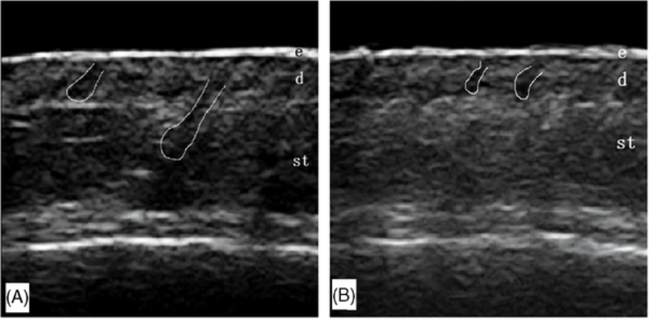 Hair follicle ultrasound