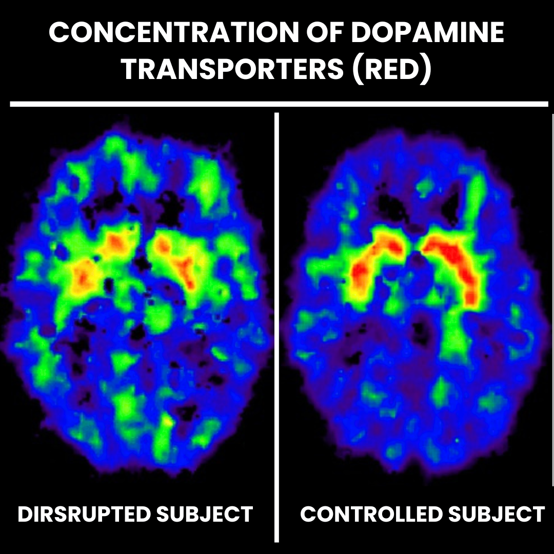 Disrupted dopamine