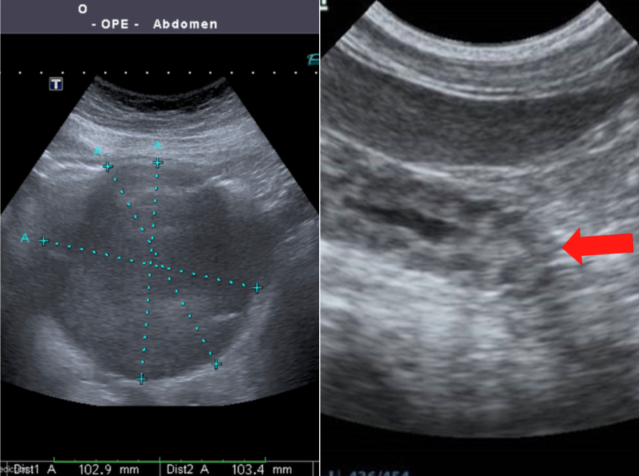 Gastric emptying ultrasound